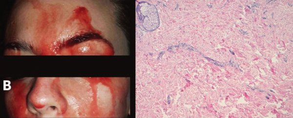 A rare condition is causing a woman to uncontrollably sweat blood