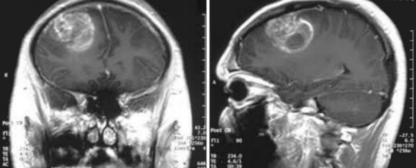 Antidepressants and blood thinners prompt brain cancer cells to eat themselves