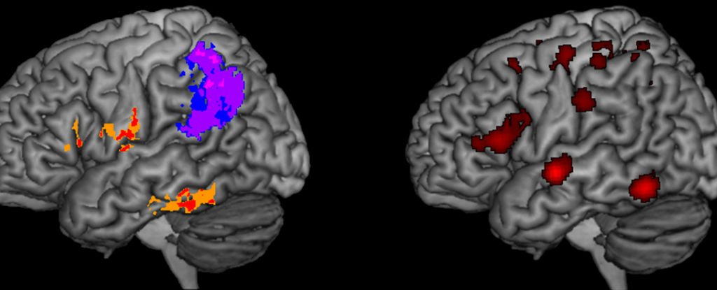 Scientists Pinpoint The Parts of The Brain That Break Our Ability to Spell