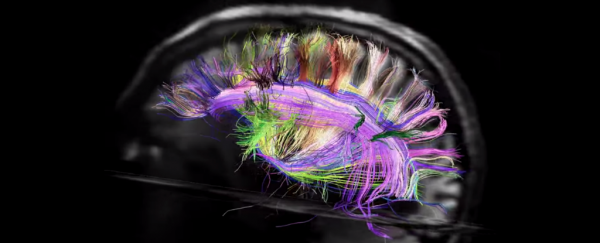 People with autism have unusually symmetrical brains, new scans reveal