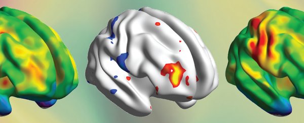 Subtle brain thinning during teen years linked to increased risk of psychosis