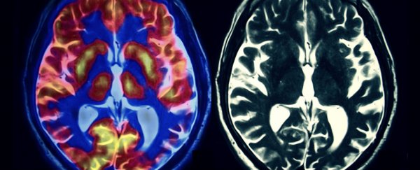 Scientists have halted Huntington's disease activity for 6 months in mice