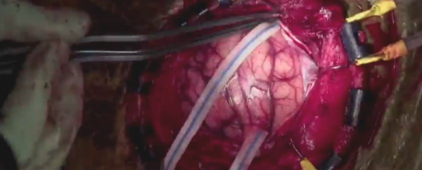 WATCH: US doctoral student films his own brain surgery