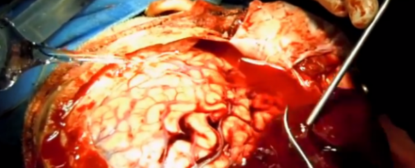 WATCH: Neurosurgeon completes full 'subdural haematoma' surgical procedure