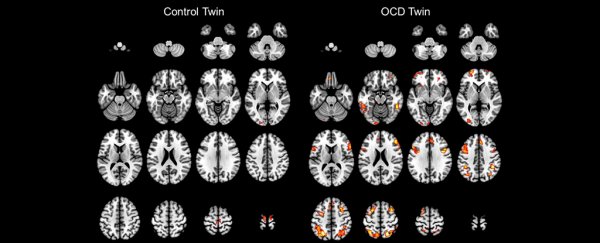 There's a simple way to convince people mental illness is a real disease