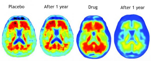New Alzheimer's drug trial clears toxic brain proteins and slows memory loss