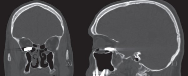This dramatic photo shows a .22 calibre bullet lodged in a man's eye socket