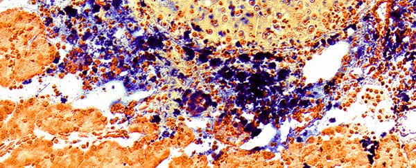 Iron nanoparticles have been shown to kickstart the immune system to destroy tumours