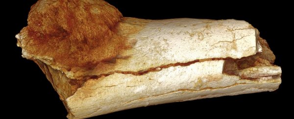 The earliest case of cancer has been found in a 1.7 million-year-old bone