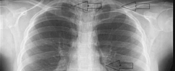 A girl screamed so hard at a One Direction concert that her lungs collapsed