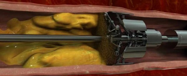 This machine could remove plaque from your arteries in minutes