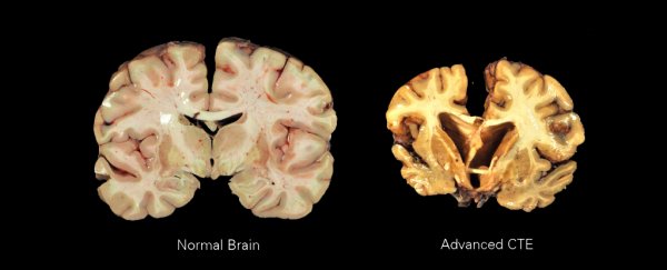 Two post-mortem brains cut in half, one shrunken and yellowed, and the other plump and healthy.