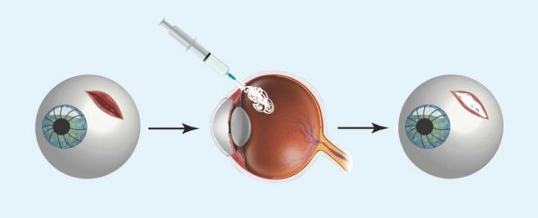 This genius eyeball 'superglue' can patch wounds and washes off with water