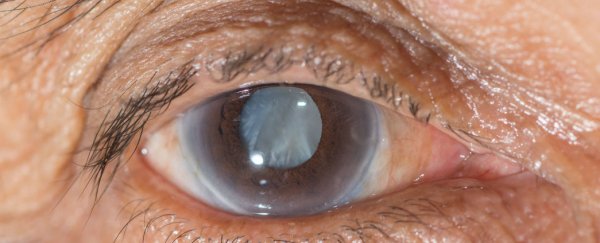 Scientists have developed an eye drop that can dissolve cataracts