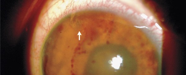 Where no flatworm has gone before: doctors find wriggling parasite in teen's eyeball