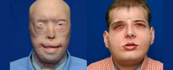 Surgeons have successfully performed the most extensive face transplant ever
