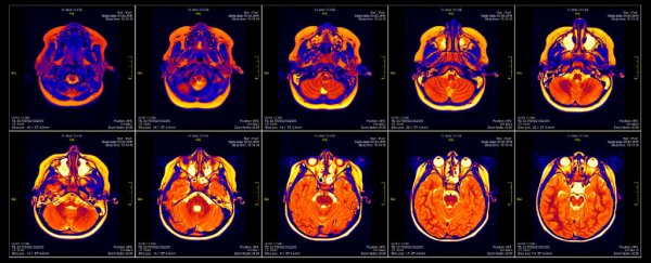 A bug in fMRI software could invalidate 15 years of brain research