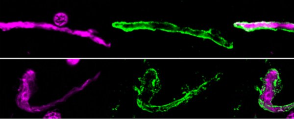 A fungal infection in the brain could be linked to Alzheimer's, study suggests