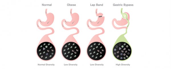 Microbes, not food restriction, could be the key to our most effective treatment for obesity