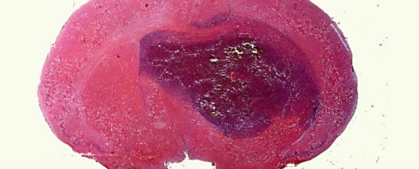 Scientists just discovered we've been looking at cancer growth all wrong