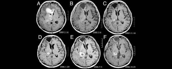 Largest ever brain cancer study provides key insight into one of its deadliest forms