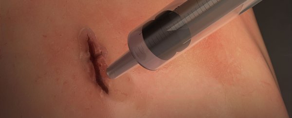 Scientists have developed surgical glue that seals wounds in 60 seconds