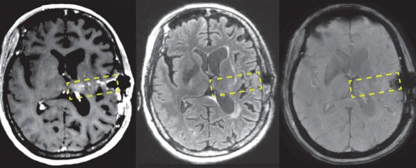 Scientists are using brain-opening 'microbubbles' to make chemo more effective