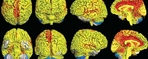 Women's brains have more blood flow than men's, new study shows