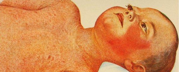 The once-deadly scarlet fever is making a weird comeback around the world