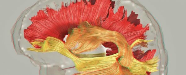 Schizophrenia fries more of the brain's wiring than we thought, study shows