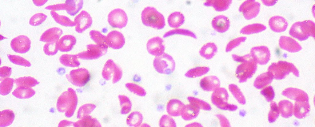 Sickle cell anemia research paper