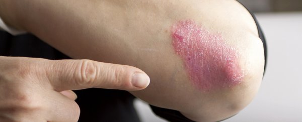 This new drug is super effective at clearing up severe psoriasis, trials find