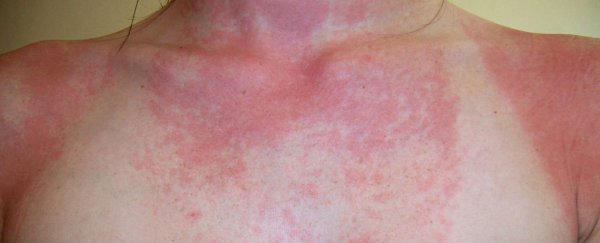 Here's why some of us develop an allergy to sunlight