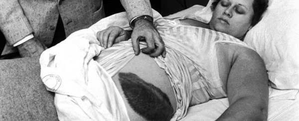 This bruise is the result of the only confirmed meteorite strike on a human ever