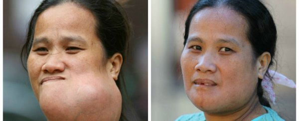 Here's how Australian surgeons removed a massive tumour from this woman's face