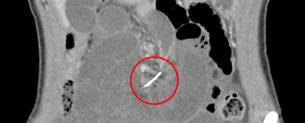 A woman swallowed a wire and it lodged in her intestines for 10 years