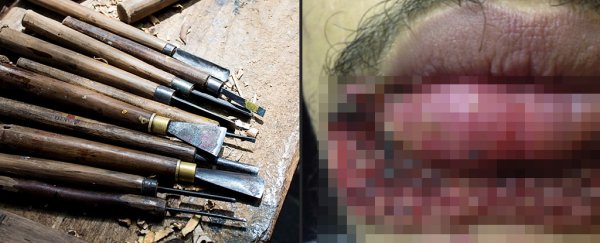 A man extracted a pimple with a carpentry blade and things went horribly wrong