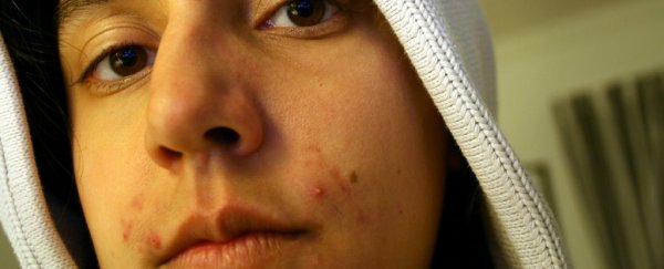 Should we be popping pimples? The answer, according to science