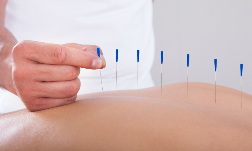 Andrew-Popov_acupuncture_shutterstock