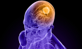 Eraxion_BrainTumour_iStock