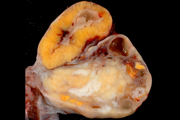 Ovary