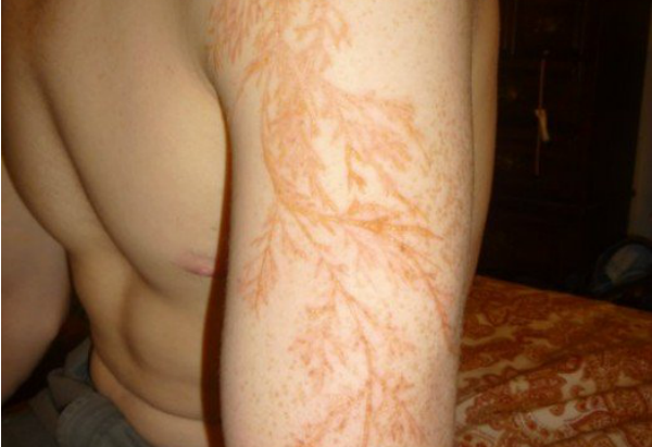 lightning scars images