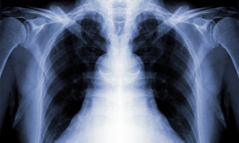 khuruzero_Lung_shutterstock